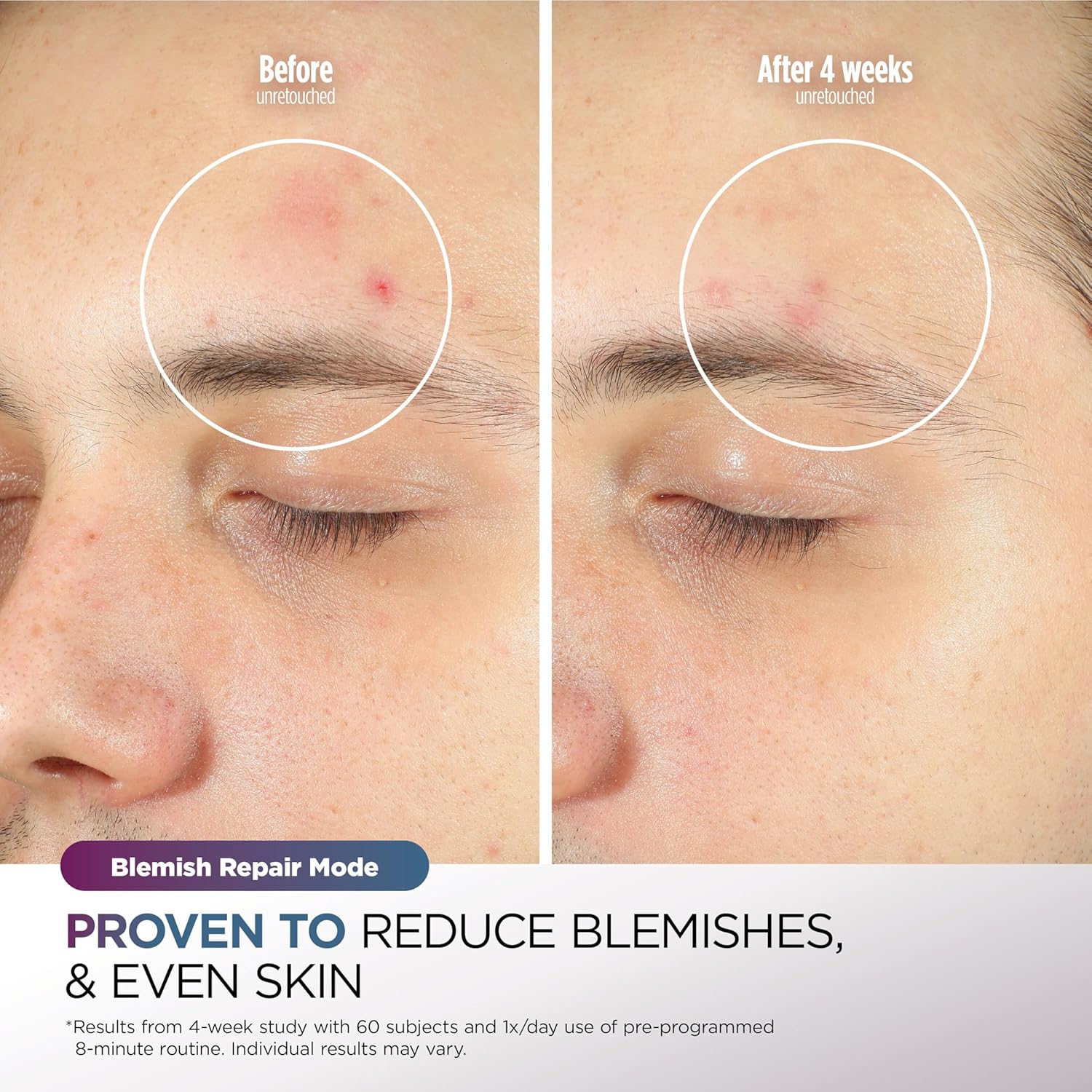 Cryoglow LED Face Mask with Under-Eye Cooling, Anti-Ageing & Blemish Repair, Red & Blue LED, Infrared Light Therapy, USB-C, Remote Control, Storage Bag, Adjustable Straps